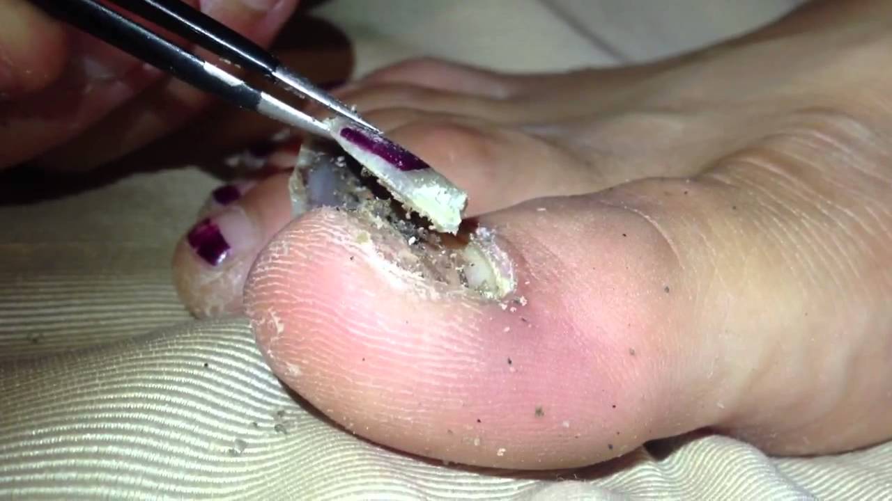 And foot hand mouth pictures And foot hand mouth pictures