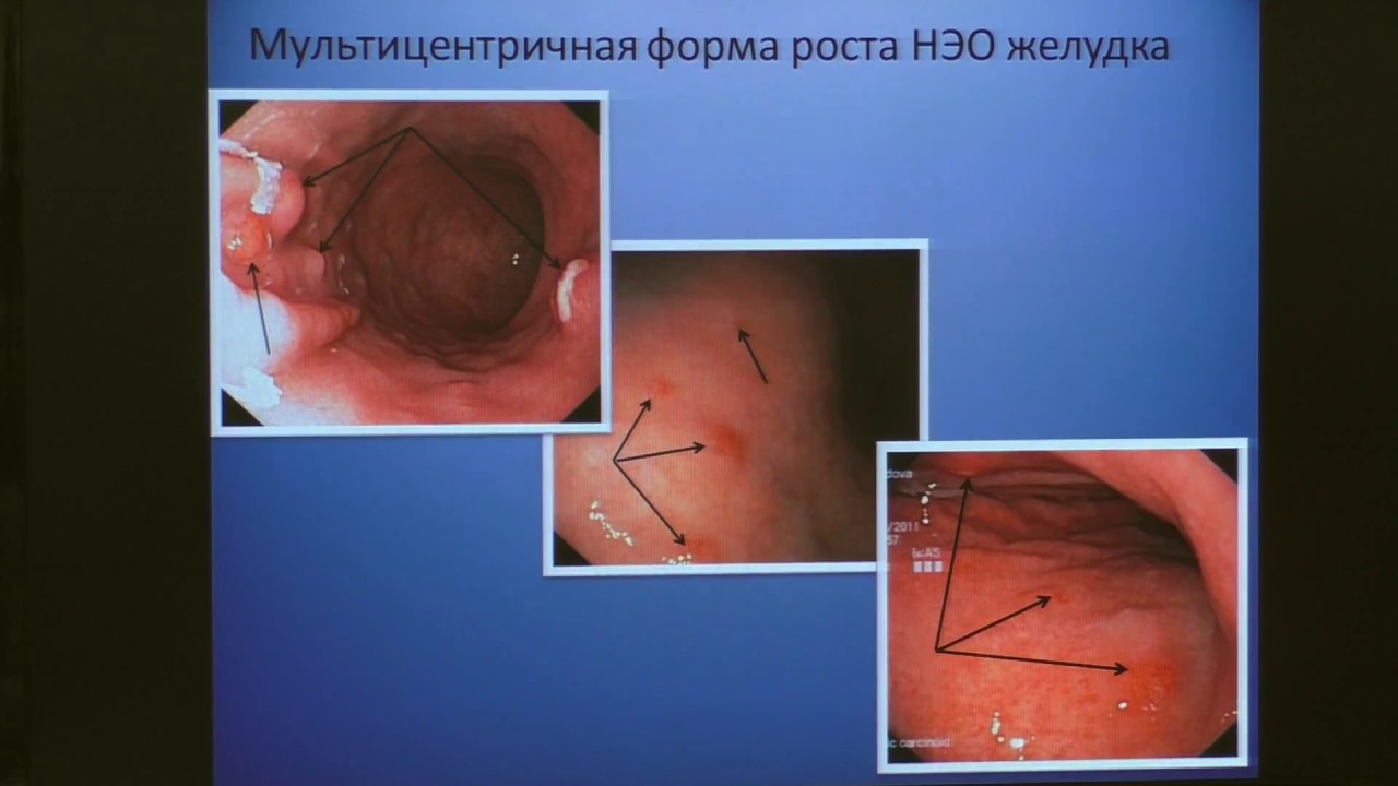 G03Малихова ОА Нейроэндокринные опухоли желудка Алгоритм диагностики и ...