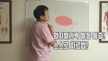 엄지발가락 발등쪽에서 나타나는 통증! 혼자서 완벽하게 치료하는법 [발등통증/ 엄지발가락 통증]