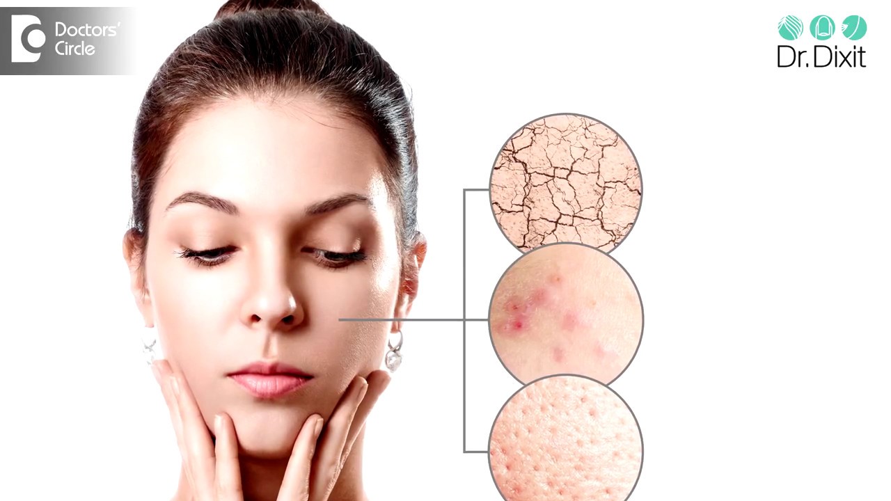 Is oily skin genetic? Is it more prone to acne? - Dr. Rasya Dixit