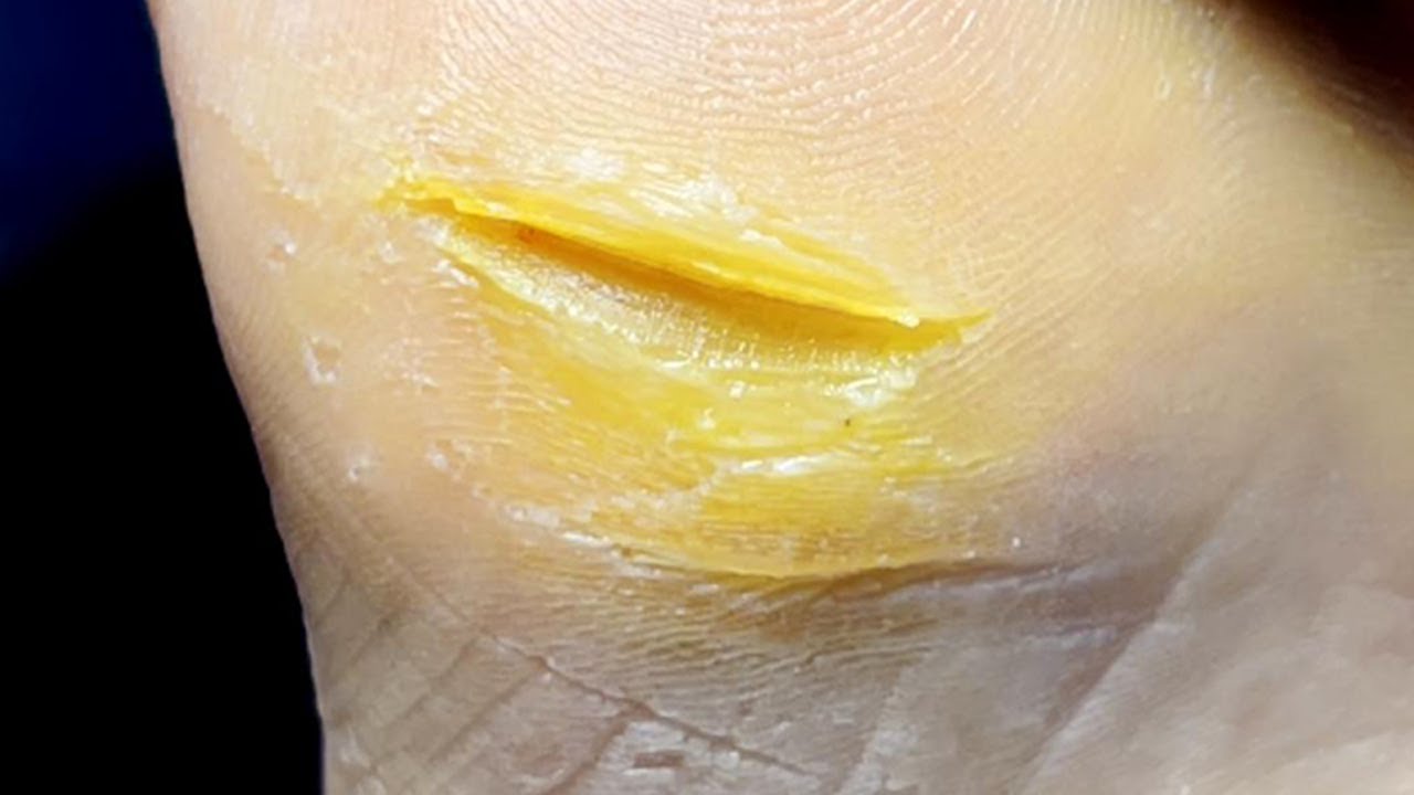 Calluses Ripping The calluses on your feet are cracked, so trim along the gaps【Pedicure ...