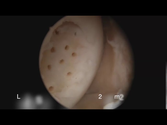 Tratamiento lesión cartilago con BST-Cargel