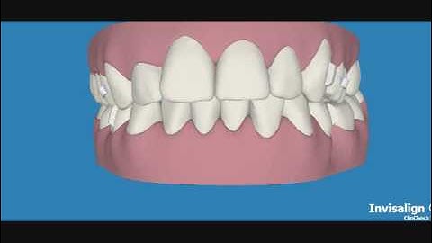 Invisalign braces treatment phase 1 from http://www.myinvisalignblog.com blog