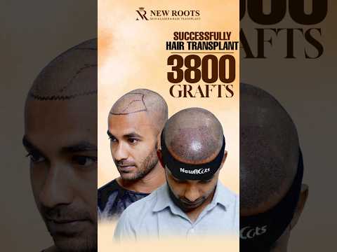 Hair Transplant in Kolkata | 3800 Grafts Implanted | Cost and Procedure #hairtransplant #shorts