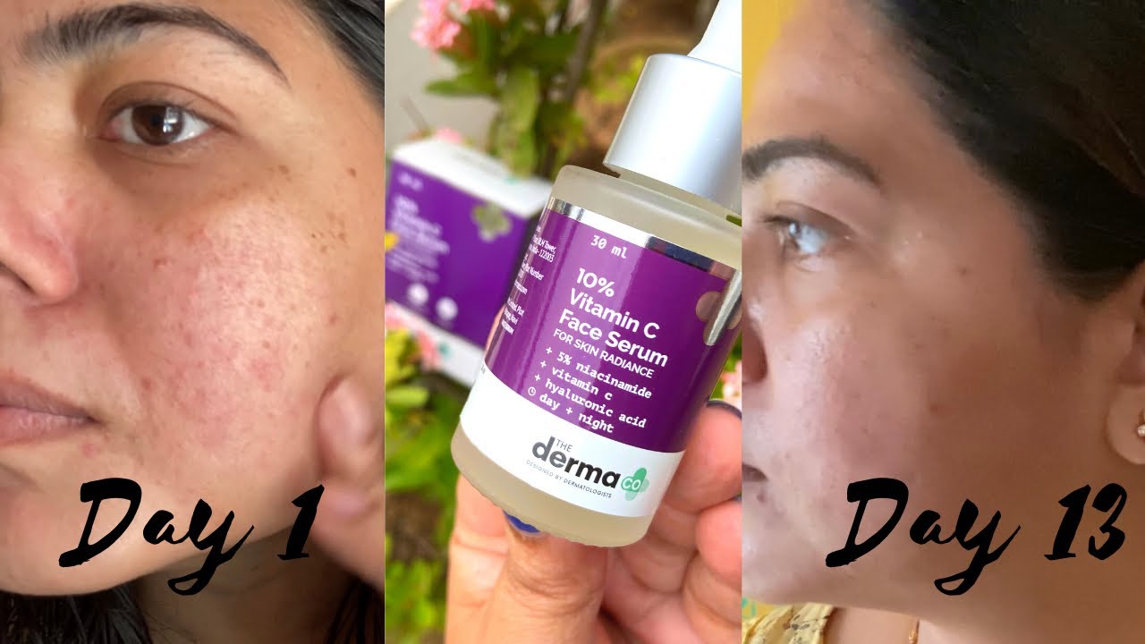 Derma co vitamin C 10% + niacinamide 5% serum | oily acne prone skin REVIEW  best vitamin C in India - YouTube