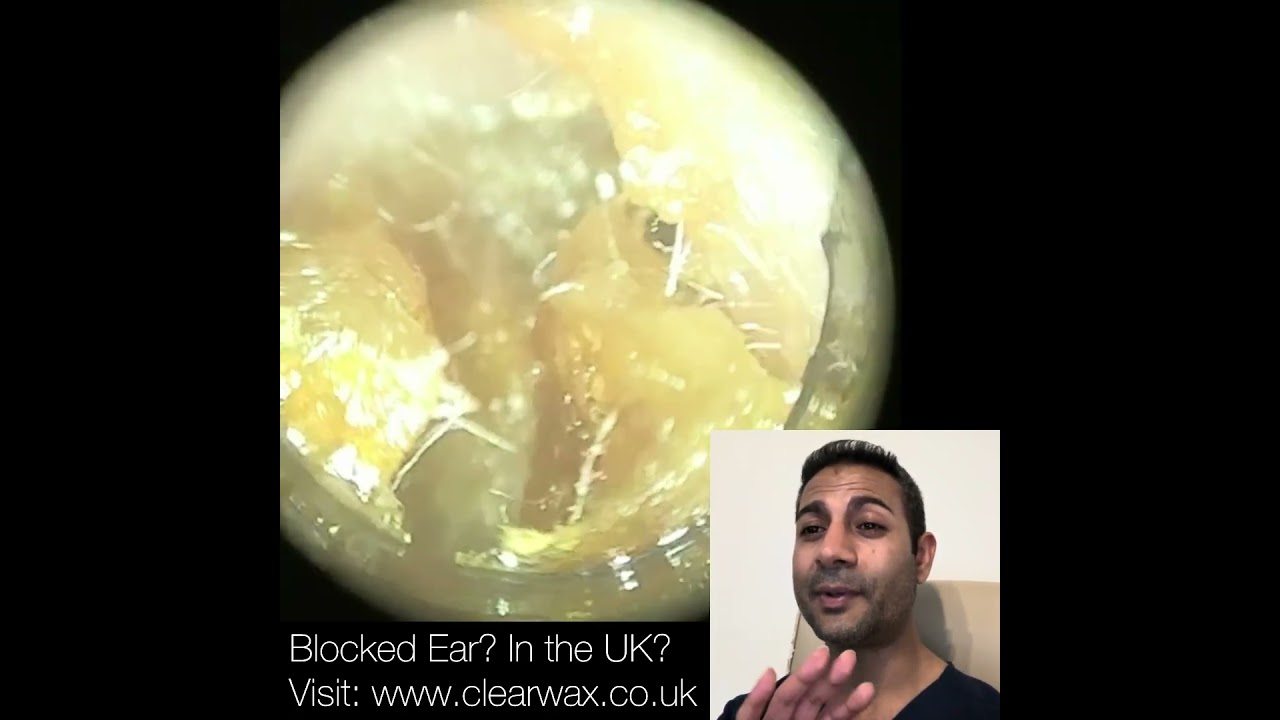 423 - Удаление ушной серы с помощью WAXscope®️