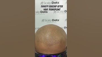 Scalp micropigmentation done after hair transplant for density buildup #scalpmicropigmentation #smp