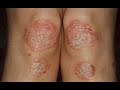 Psoriasis