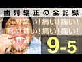 マルチループワイヤーで上の歯を奥に動かす「痛い痛い痛い！！」 歯列矯正の記録9-5