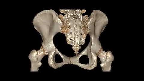 3D volume rendered pelvis