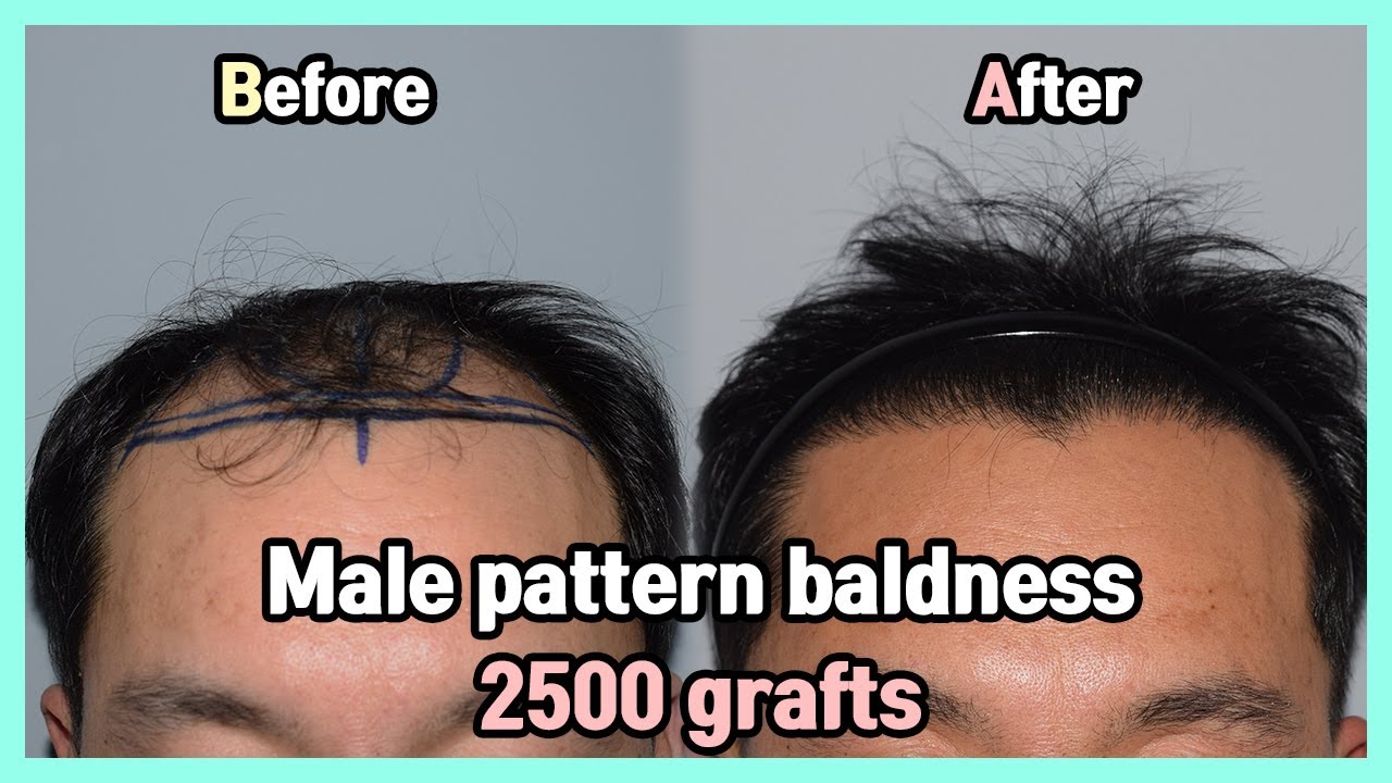 Male pattern baldness 2500 grafts (5500 hair follicles) YouTube