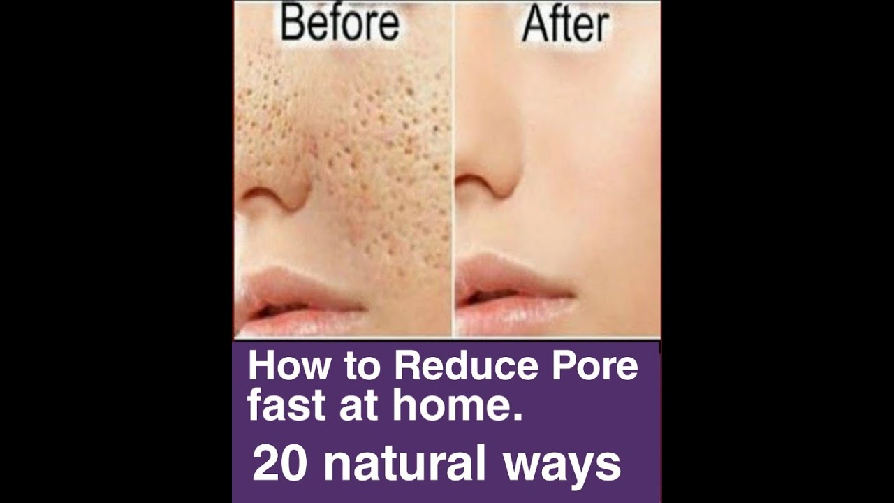 How to get rid of the large pores at home fast. 20 ways - YouTube