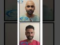 🤩How Many Grafts are Required for Hair Transplant?#shorts #shortsfeed #viral