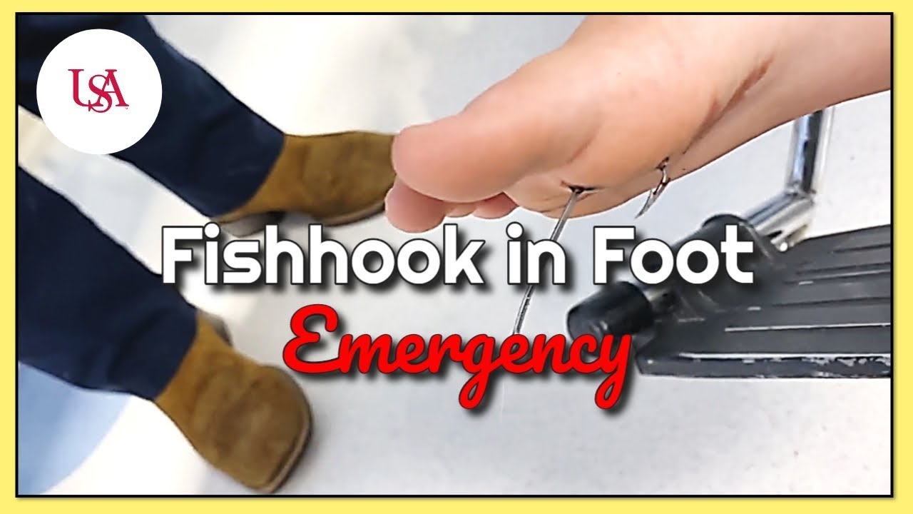 Fishhook in Foot Emergency 