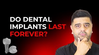✅ The Truth About Dental Implant Lifespan (Dentists Don’t Want You to Know)