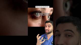 What Causes Tear Burns? #crying
