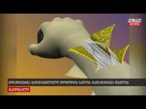 ქირურგებმა გარდაცვლილი დონორის ხელის გადანერგვა შეძლეს