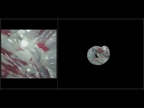 Mosaicing Software being used in Real-Time fetal fibronectin