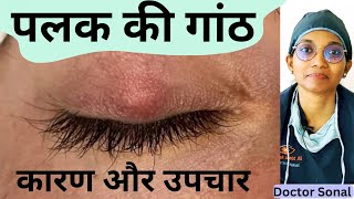 पलक मे गांठ - लक्षण, कारण, इलाज| Home Remedies Chalazion| Eyelid Cyst| Doctor Sonal