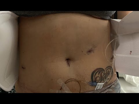 laparoscopic hysterectomy before and after