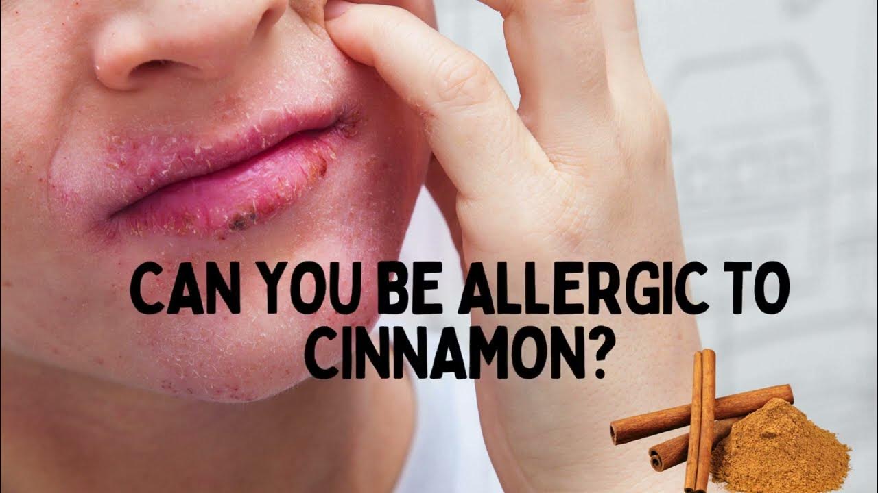Can You Be Allergic To Cinnamon? YouTube