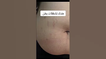 عند ك تشققات بطن مزعجة الحل الوحيد 