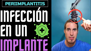 ¿Es frecuente que los implantes dentales se infecten?