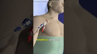"Tunneled Dialysis Catheter Placement ( 3D Animation)#dialysiscatheter #tunneleddialysiscatheter "