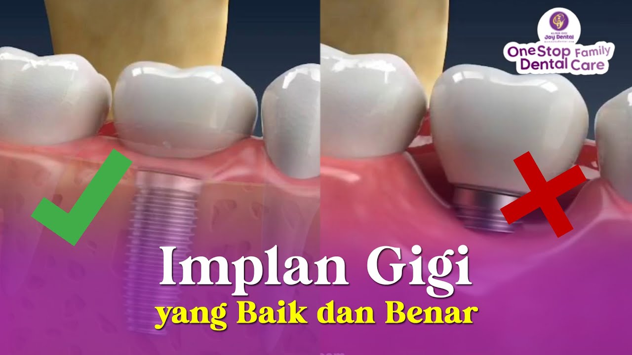 INILAH IMPLANT GIGI YANG BENAR DAN SEHAT