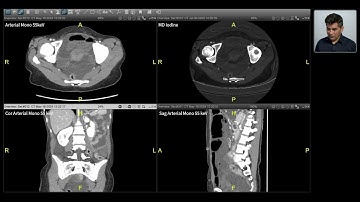 Spectral Imaging - Bowel Ischemia