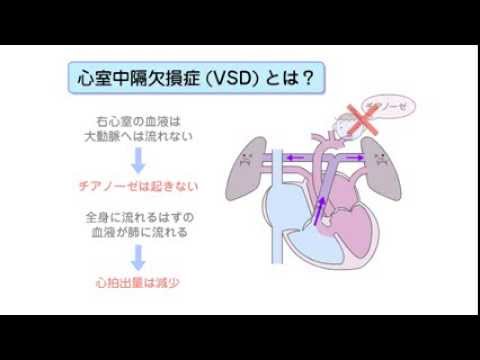 先天性心疾患　心室中隔欠損症（VSD）とファロー四徴症（TOF）