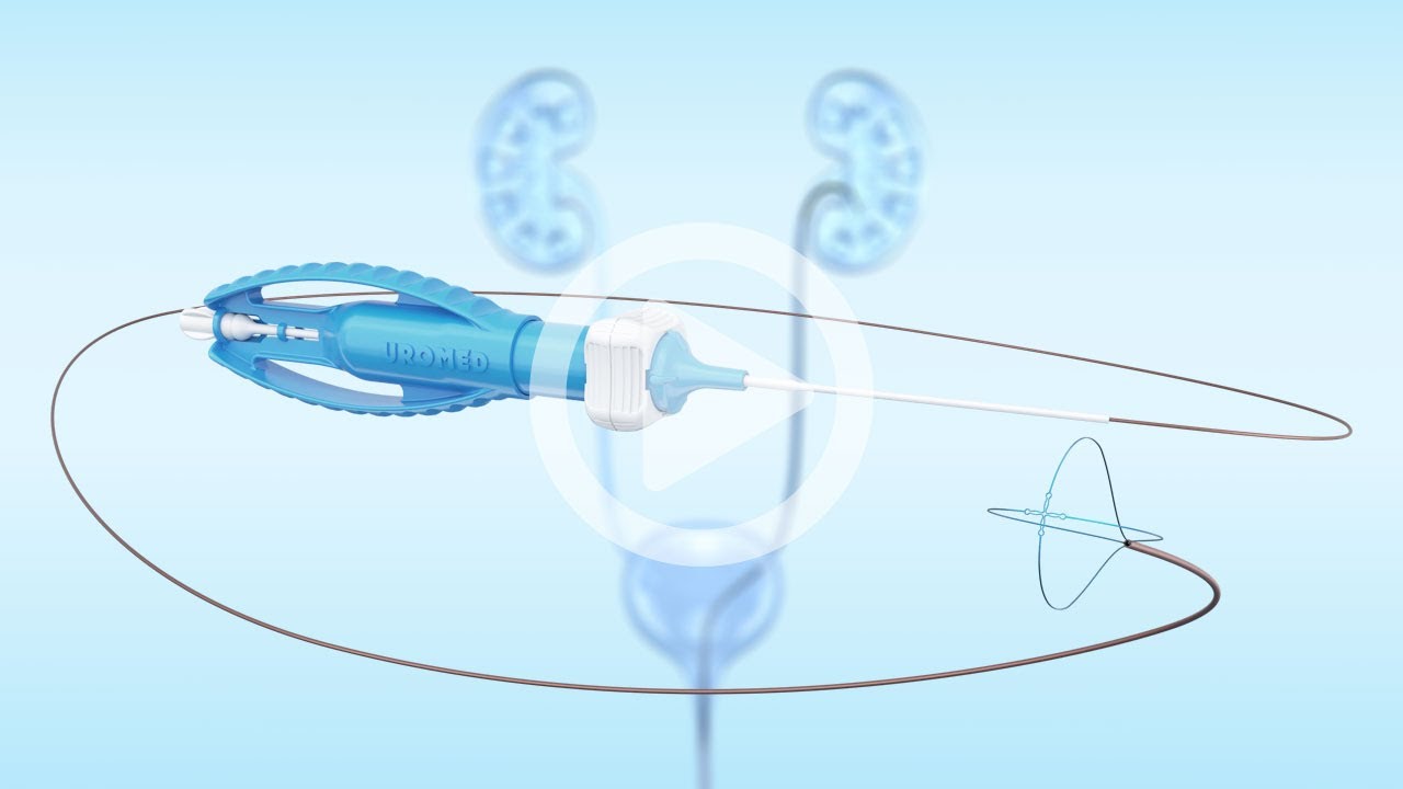 UROMED STONIZER® ROTAR360 Steinfangkörbchen mit patentierter Magnettechnologie