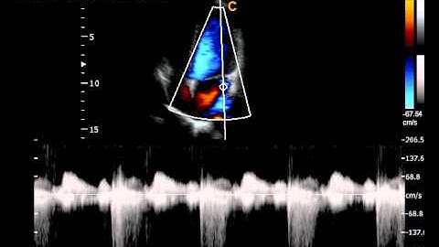 Chison Qbit Color Doppler Cardiac Continuos Wave Sonography short video