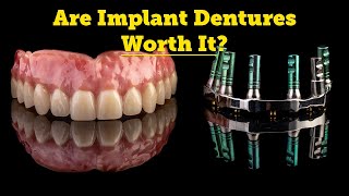 Denture FAQs - Types of Implant Dentures (Snap-On Dentures) by Utica Dental Lab 9,372 views 1 year ago 5 minutes, 12 seconds