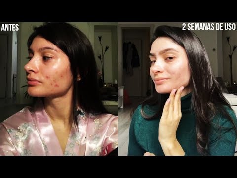 Vídeo: Rosamet - Instruções, Uso De Creme Para Acne, Preço, Avaliações, Análogos