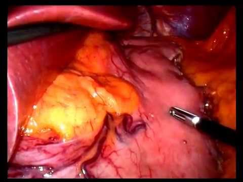 Doç. Dr. Ayhan MESCİ- Laparoskopik Sleeve Gastrektomi (Unedited Video)
