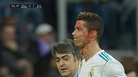 Cristiano Ronaldo INJURY Bleeding Goal - Real Madrid vs Deportivo - DayDayNews