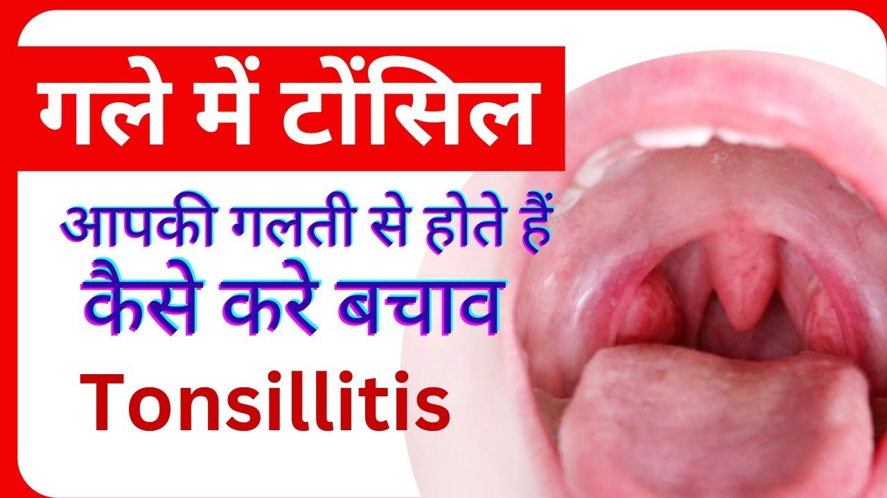 किन गलतियों से होते है टोंसिल ( tonsils ) कैसे करे बचाव tonsil kyu