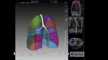 IQQA®-BodyImaging for Lung Segmentectomy Planning