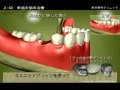 米沢歯科クリニック（徳島）　歯を失った方への３つの治療方法について