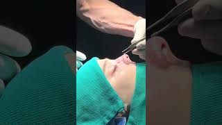 Correct asymmetrical nasal bone technique! Rhinoplasty In NYC and NOLA