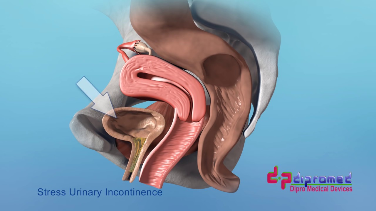 Stress Urinary Incontinence