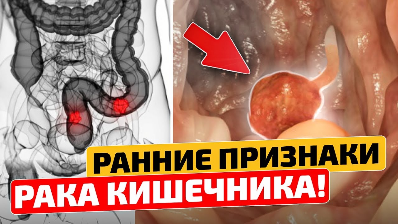 Онколог: ЭТО первые симптомы рака толстой кишки! - YouTube