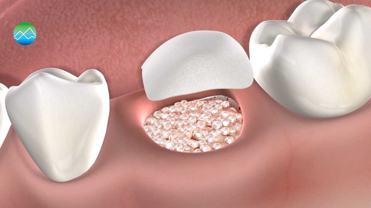 Bone Grafting Kitsap Oral, Maxillofacial & Dental Implant Surgery