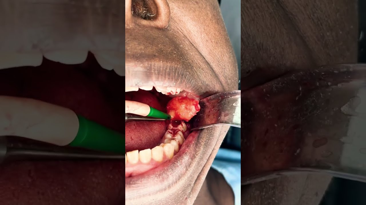 Wisdom Tooth Removal Cyst Painless Dental Procedure Shorts Health Beautiful