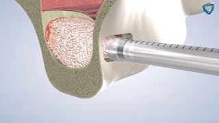 Sinus Lift at Columbia Basin Oral & Maxillofacial Surgeons