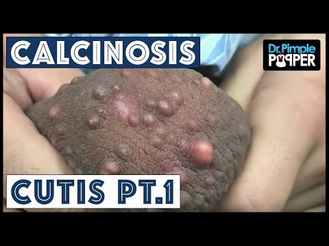 Removing Calcinosis Cutis: Pt.1