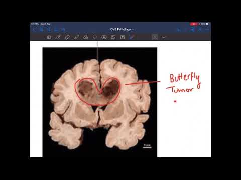 Pathology- CNS Tumors with important questions