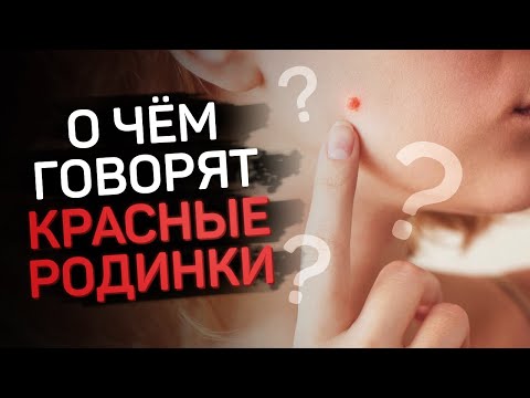 Что значат красные родинки на теле?