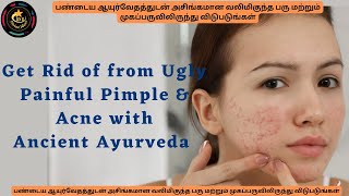 Get Pimples free skin with Ancient Ayurveda/ప్రాచీన ఆయుర్వేదంతో మొటిమలు లేని చర్మం